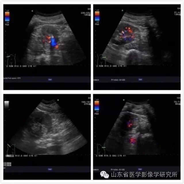 山東省醫學影像學研究所科室簡介（三）——超聲介入診療研究室 健康 第12張