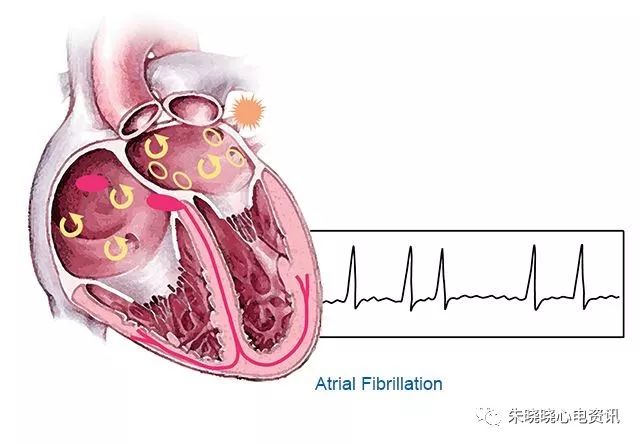 【心电合集】房颤系列合辑