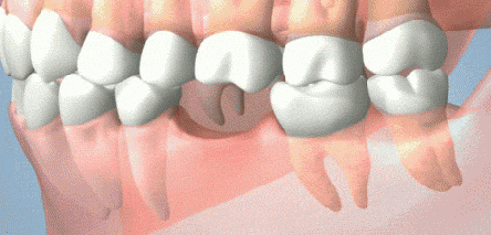 缺牙者比牙齿健全者患癌比例高3成 还不赶快