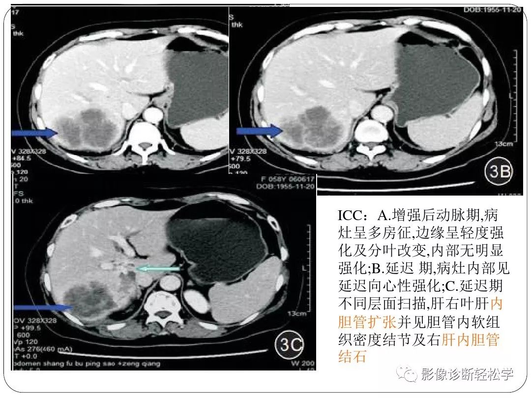 【每日一例| 480例】肝脓肿的诊断及鉴别