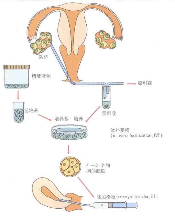 "人工授精不同于试管婴儿,只是将精子注入女性的生殖道,卵母细胞和