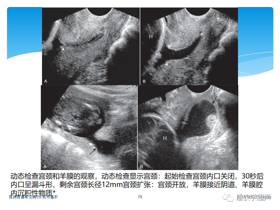 超声微课堂宫颈阴道常见病超声诊断宫颈机能不全超声检查