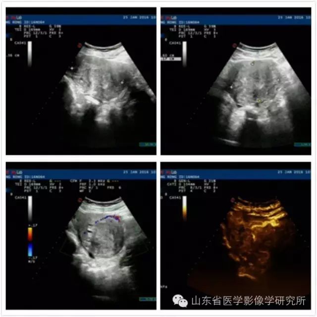 山東省醫學影像學研究所科室簡介（三）——超聲介入診療研究室 未分類 第10張