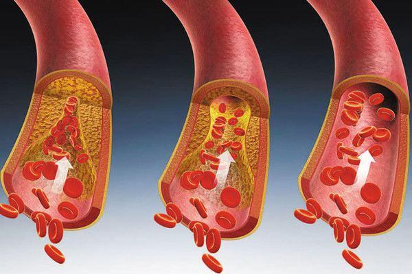 血管好人長壽，45歲以上的人冬天保護血管健康，少吃3種紅色食物 未分類 第1張