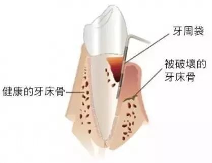 健康傳播 | 洗牙這麼多「門道」，你都知道嗎？ 未分類 第4張