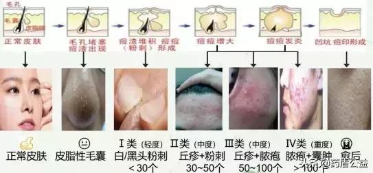 痤疮的发展过程及其对应临床状态和分级