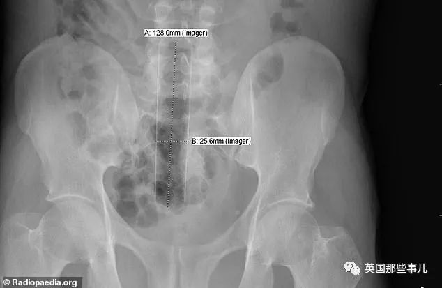 這些患者心真大，什麼都敢往自己身體里塞！ 未分類 第3張