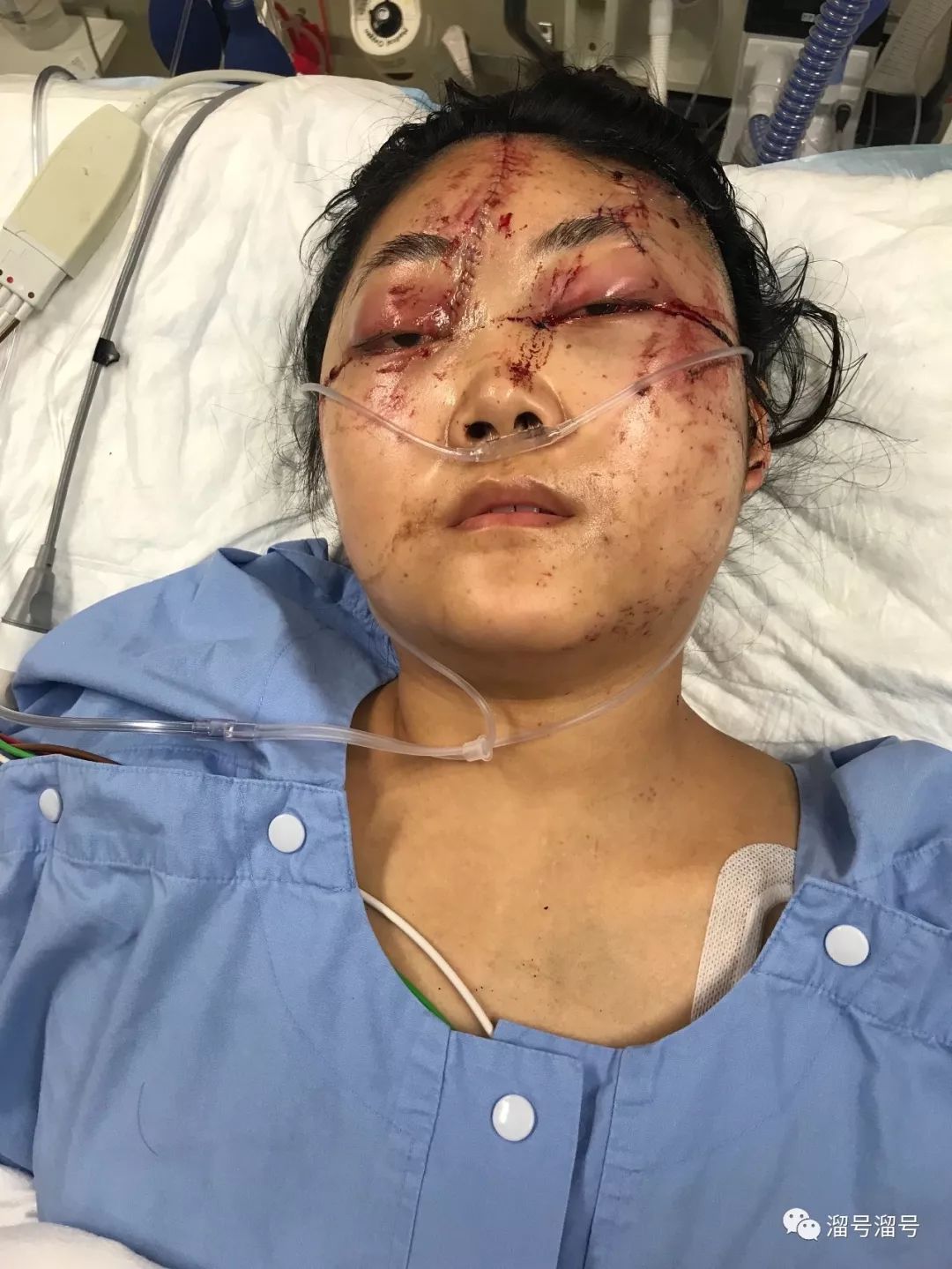 感人华人女孩在珀斯遭遇重大车祸满身伤口内心却无比坚强女孩回忆事件