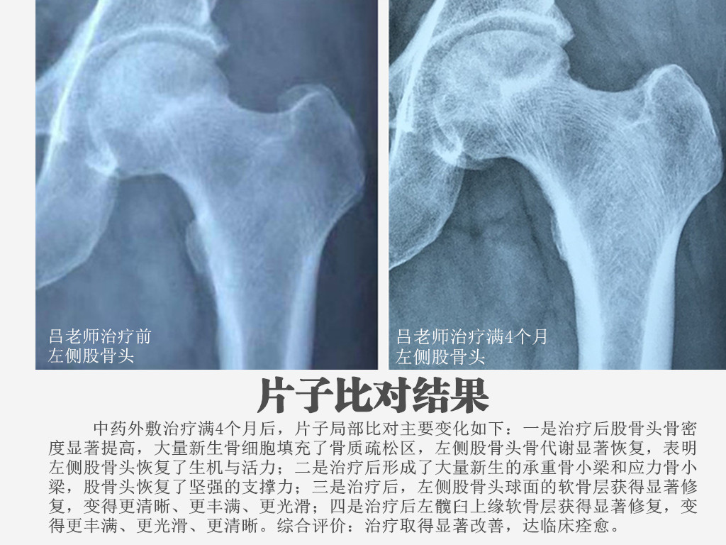 股骨头坏死中药外敷治疗4个月,x线片显示会怎样?
