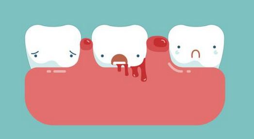 這些原因可致牙齦出血 未分類 第1張
