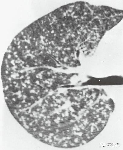 粟粒性肺结核