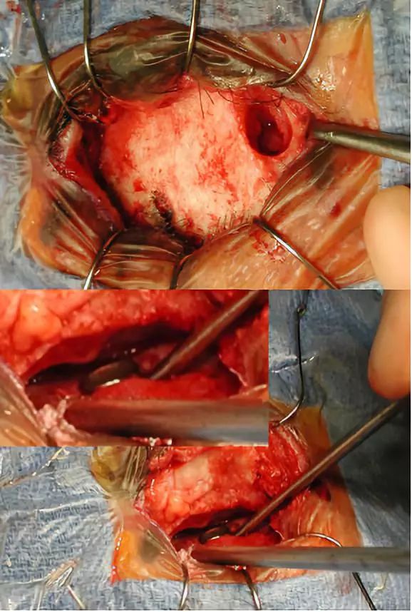nexus手术技巧丨第六期:眶上入路手术策略与技巧_额窦