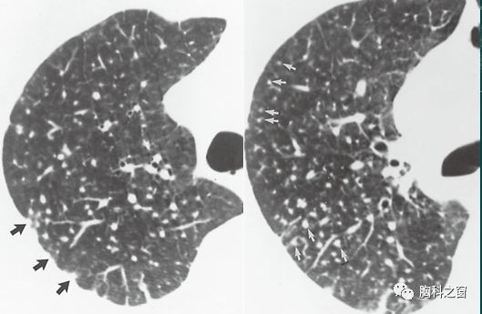 专家手把手教你看图说话肺间质疾病