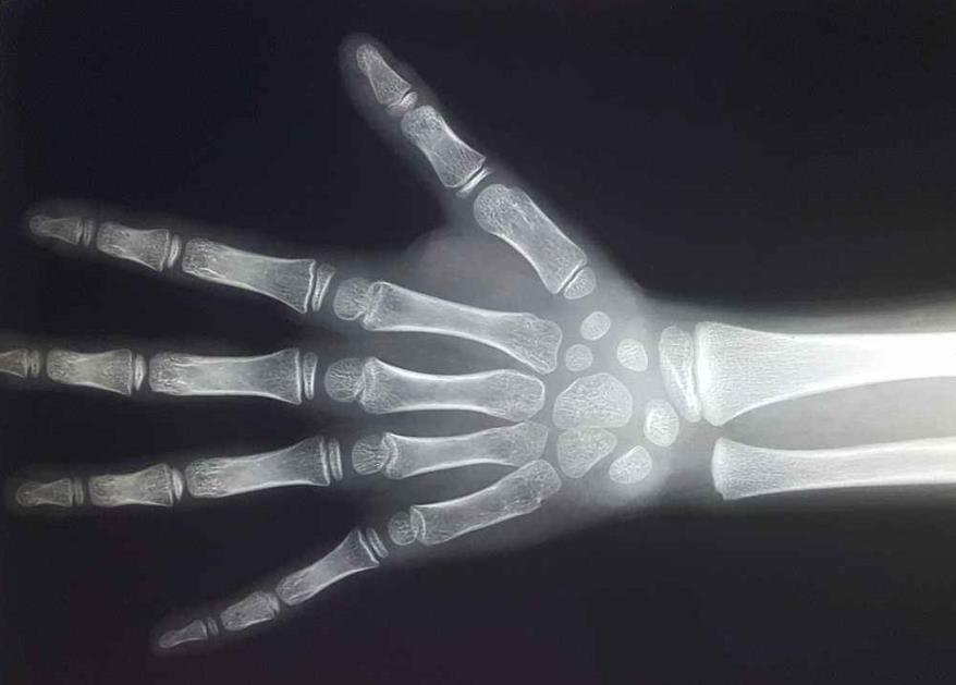 这个问题比较专业,通常是拍摄左手腕部的x光片,医生通过x光片观察