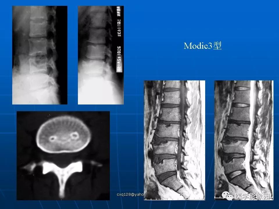 椎体终板骨软骨炎的影像学表现影像天地