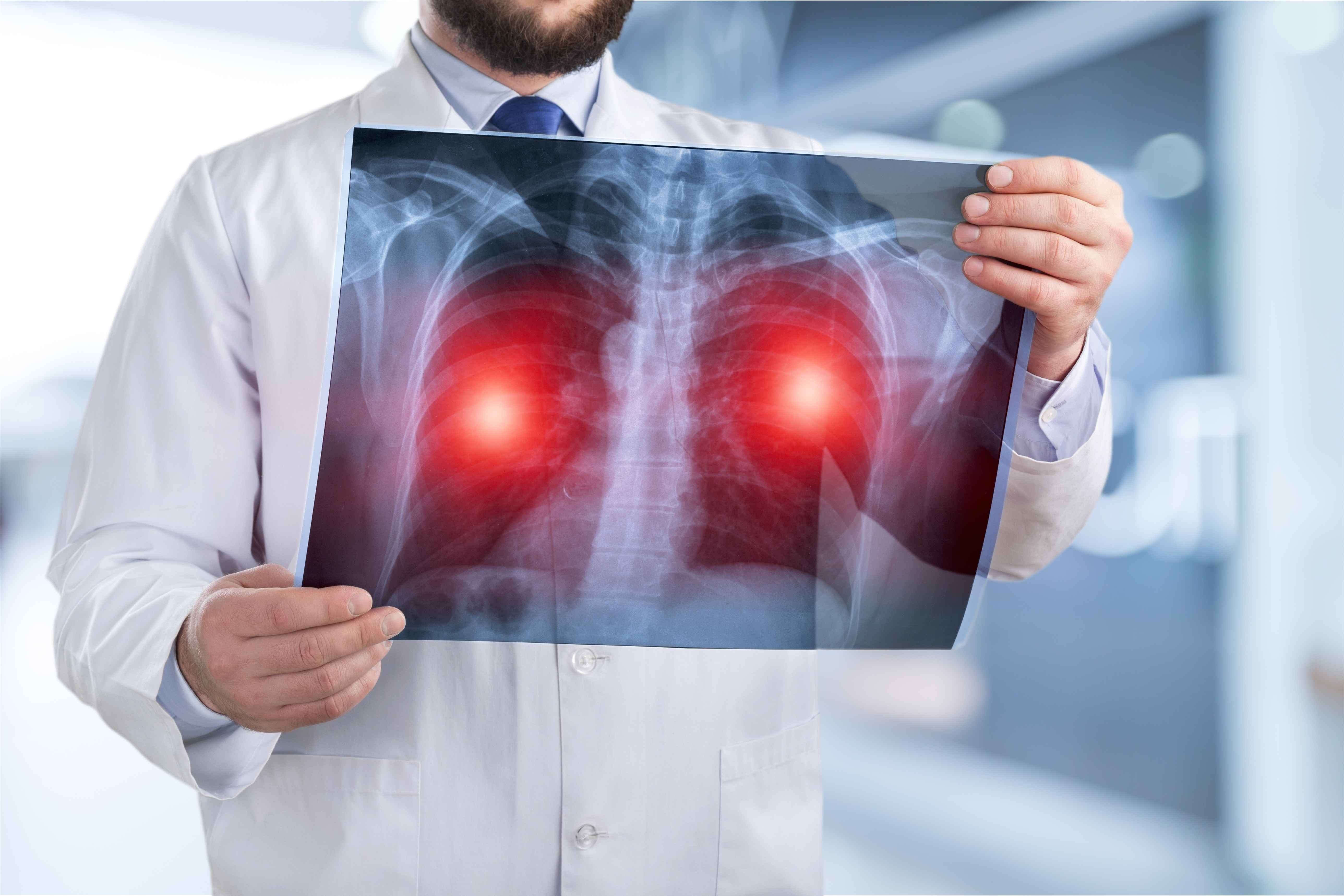 年年體檢正常，為何還會查出肺癌晚期？醫生：只因你沒做好這事 健康 第2張