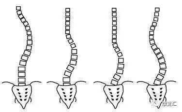 5人的脊柱侧弯超过25度.有60%的弯曲在青春期前曲度增长很快.