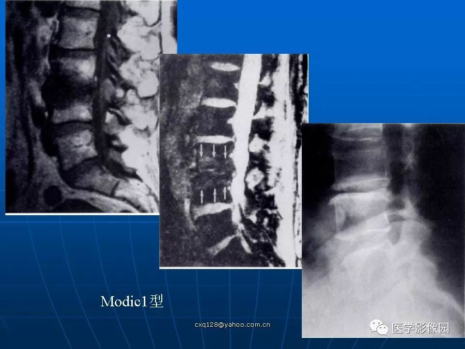 椎体终板骨软骨炎的影像学表现影像天地