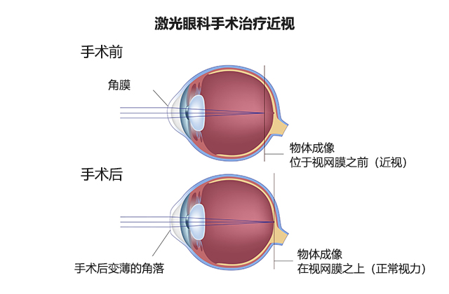 較為安全的近視手術有三種 未分類 第1張
