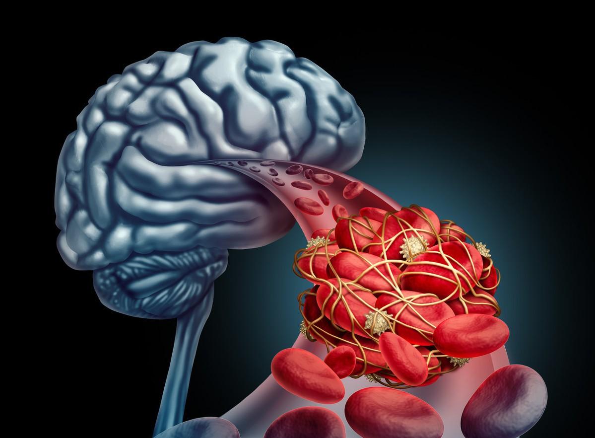 阿司匹林長期服用，有可能造成腦出血麼？對大腦有什麼影響？ 未分類 第3張