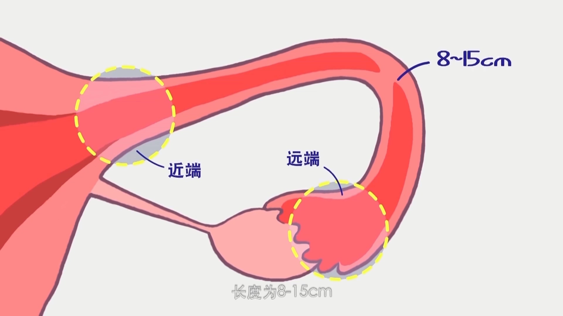 输卵管是自然受孕过程中必须的通道,它是一对细长而弯曲的管子,同两