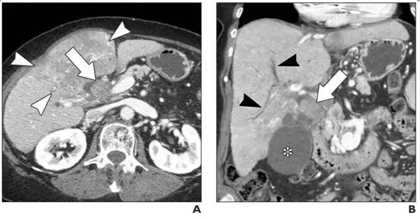 超全总结:不典型肝癌的各类影像表现与病例详解!