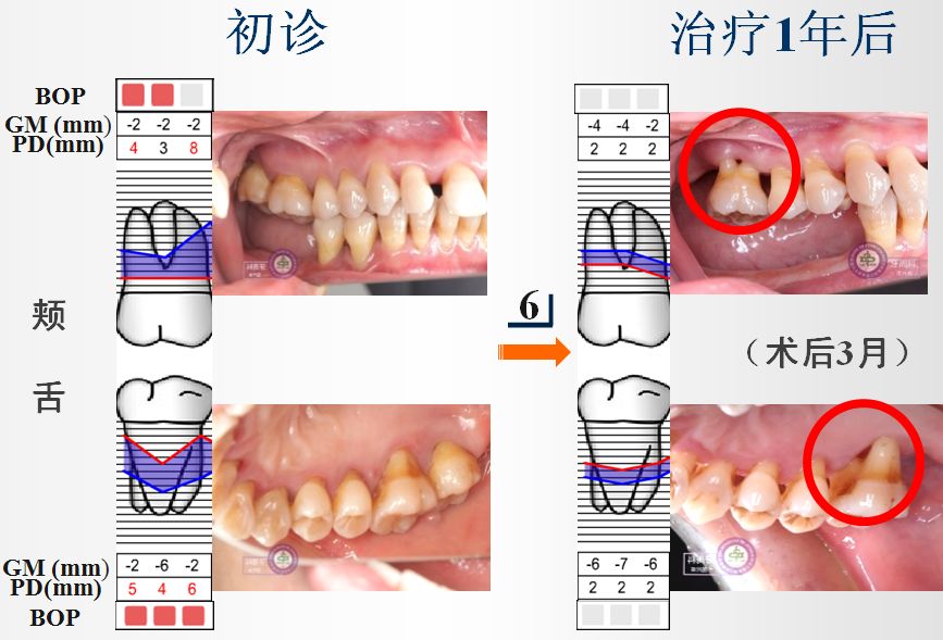 重度慢性牙周炎的序列治疗一例以菌斑控制为导向的牙周治疗2018病例展