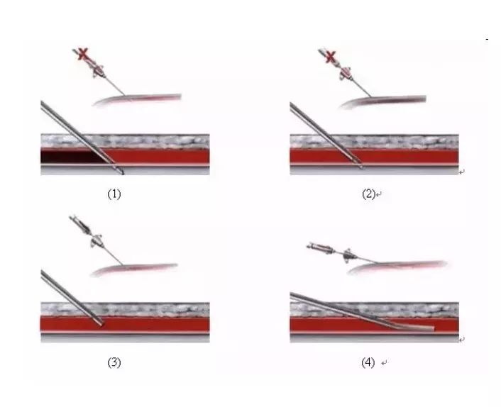 动脉针穿刺屡战屡败,问题到底出在哪儿?