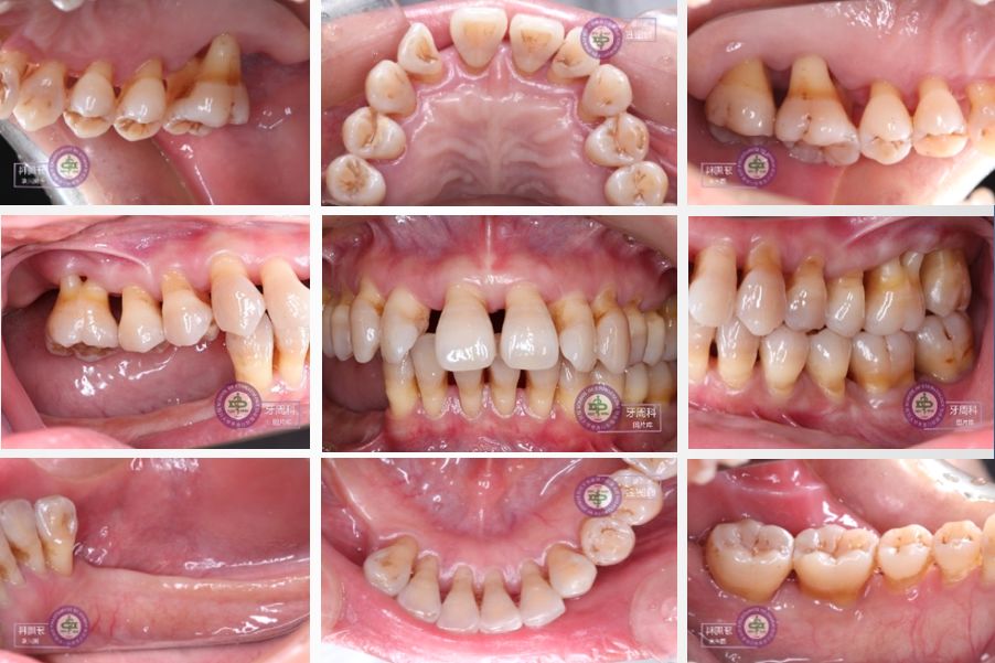 重度慢性牙周炎的序列治疗一例以菌斑控制为导向的牙周治疗2018病例展
