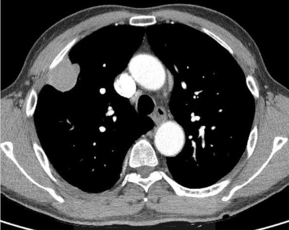 图1 图2 图3 图4 诊断:恶性胸膜间皮瘤(malignant pleural