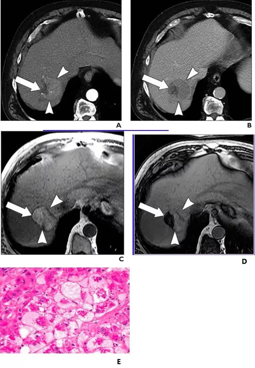 超全总结:不典型肝癌的各类影像表现与病例详解!