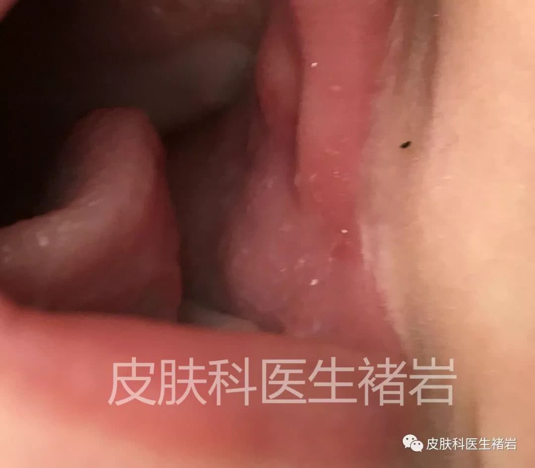 如果宝宝发烧出疹子之后,反而烧的更厉害了!家