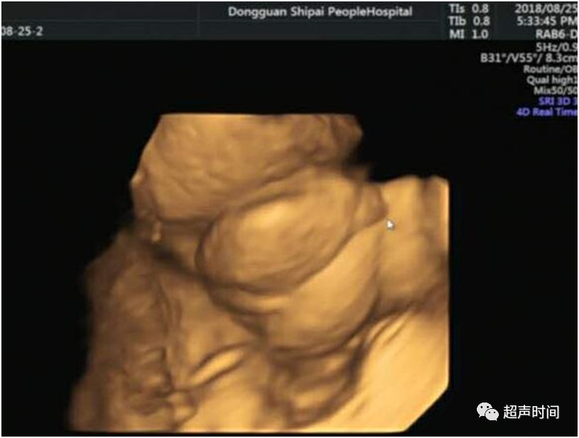 超声典型病例:胎儿尿道下裂
