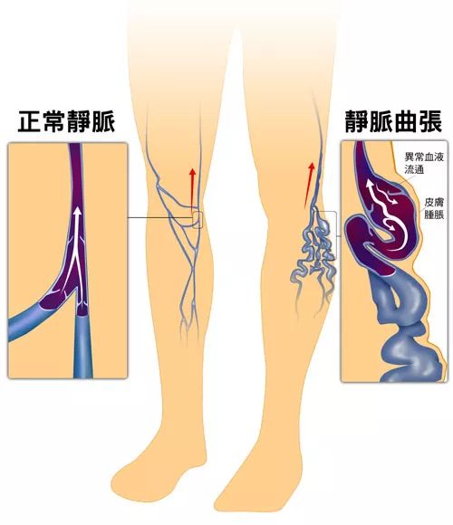 【科普】患有大隐静脉曲张该如何治疗?专家为你作出最合理的选择