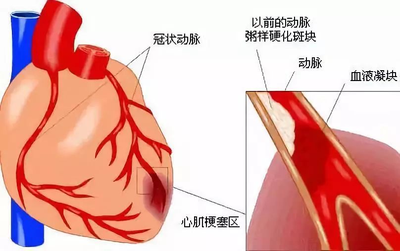 心脏搭脉停博是怎么意思_心脏搭桥是怎么回事(3)