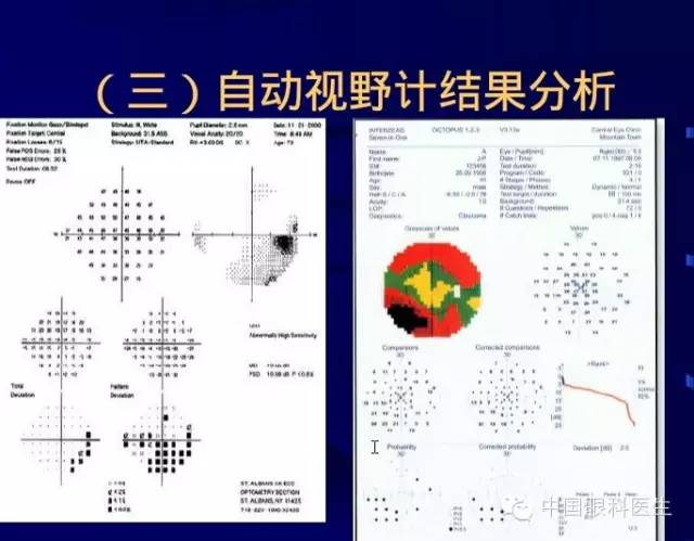 高手支招:视野计及其检查,判读方法