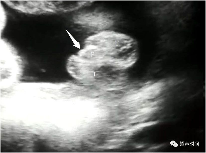 超声典型病例:胎儿尿道下裂