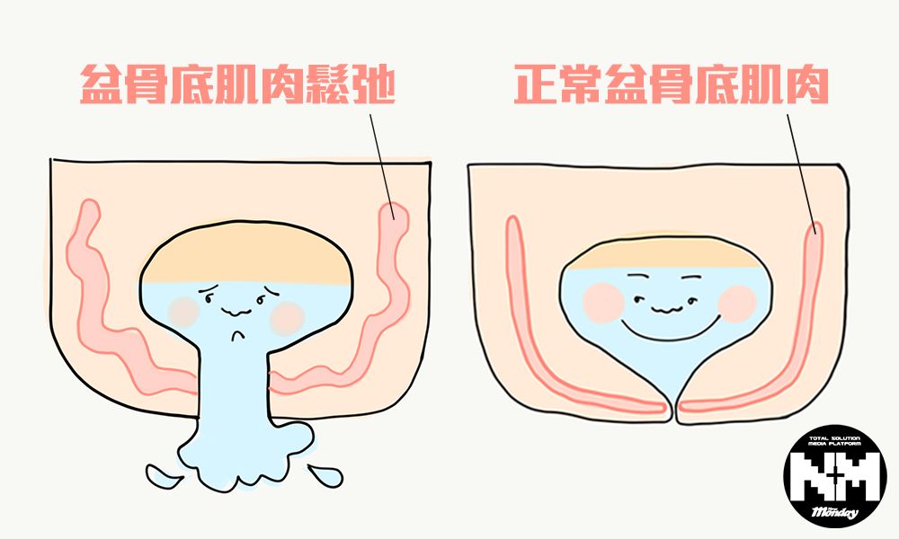 盆骨底肌肉松弛=失禁,子宫或膀胱下垂,性功能障碍!