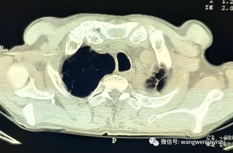 去年9月在外院行ct检查,提示胸壁肿瘤,向纵隔方向生长,但并未形成纵隔