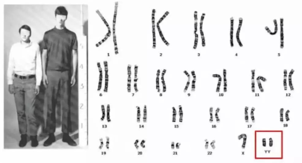 核型为(47,xyy); 女性多了一条(或几条)x染色体,则为 "超雌综合征"