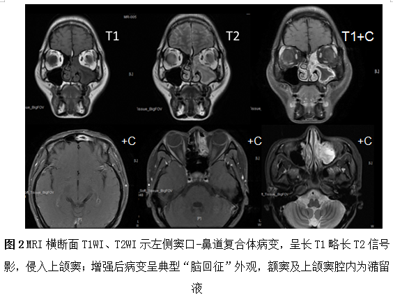 長期鼻塞、流涕  需警惕這個病！ 未分類 第2張