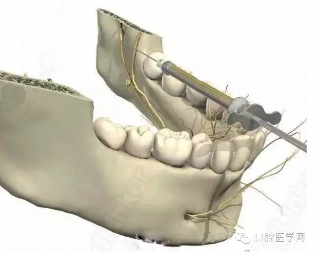 舌神经阻滞麻醉 下牙槽神经麻醉后,注射针退出1cm,注射麻药0.