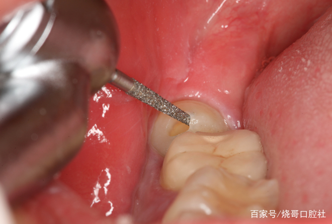 后期肉芽组织病变,局部长出一块牙龈息肉,还得切除处理