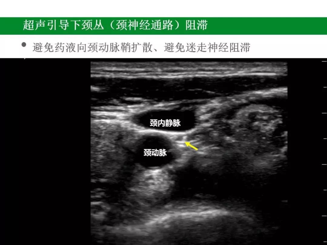 神经阻滞第一弹超声引导下颈丛阻滞在甲状旁腺手术中的应用