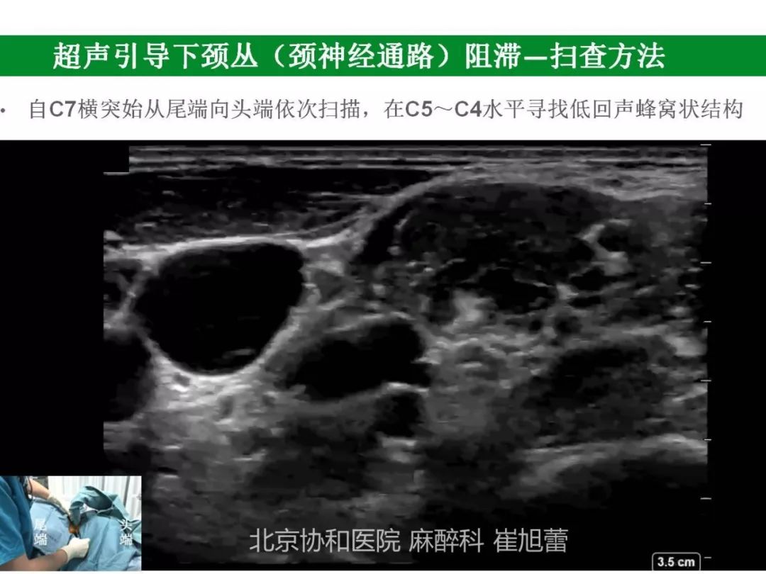 神经阻滞第一弹超声引导下颈丛阻滞在甲状旁腺手术中的应用