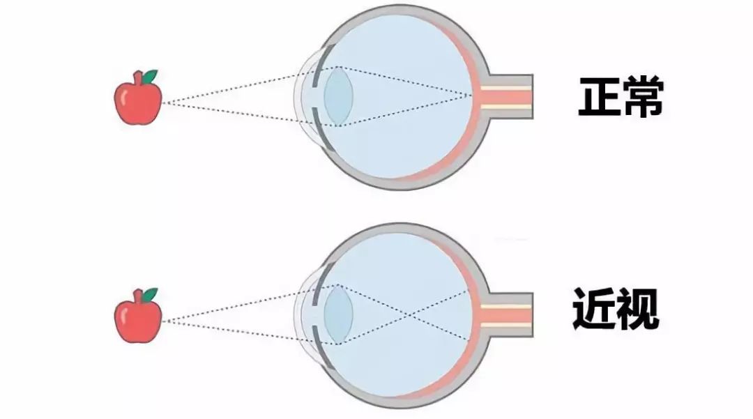 近视也分很多种,你知道吗?