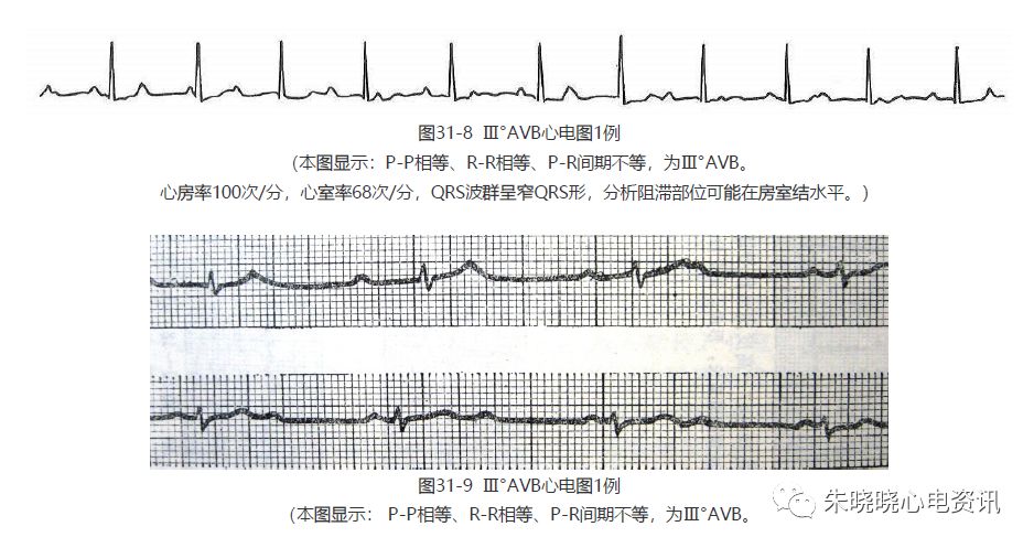 这样就形成在心脏内存在两个互相无关联的起搏点,即完全性房室分离.