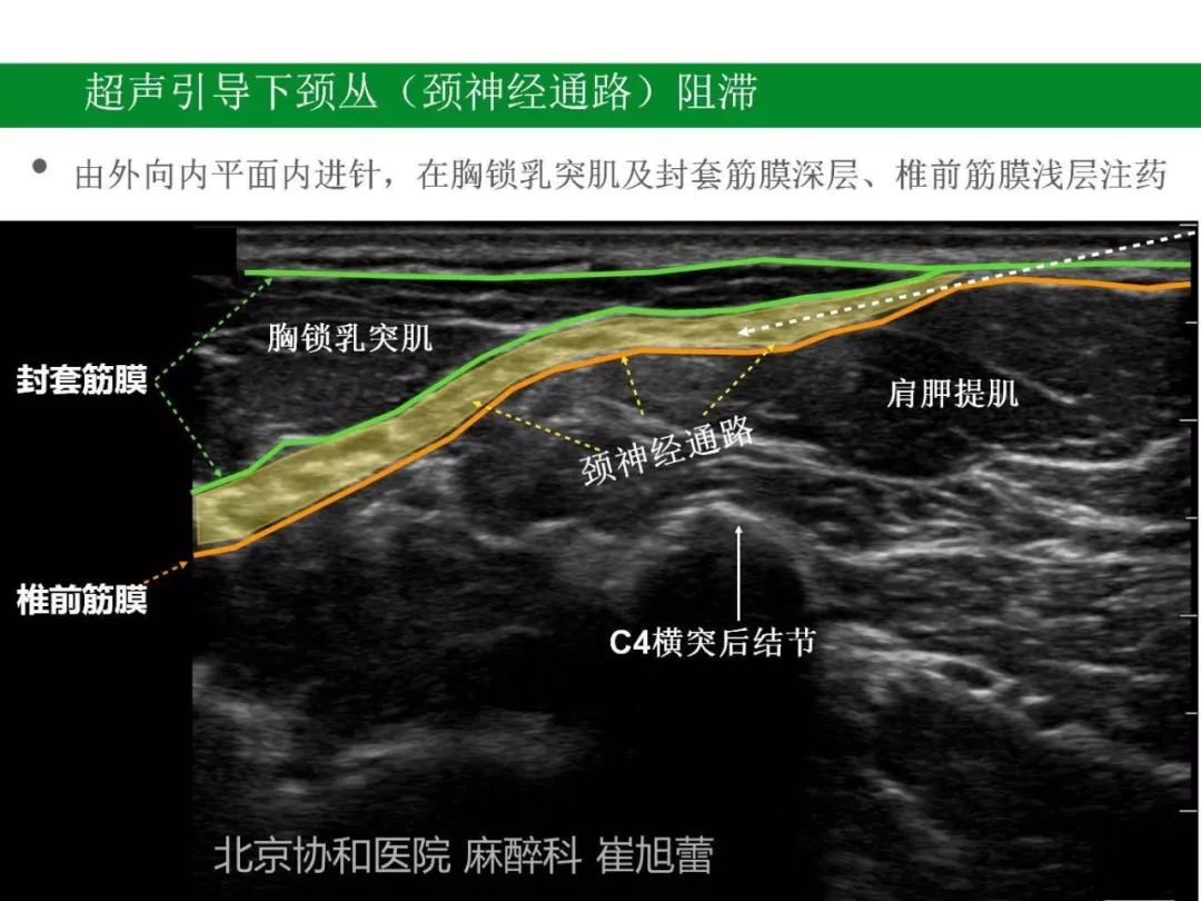 神经阻滞第一弹超声引导下颈丛阻滞在甲状旁腺手术中的应用