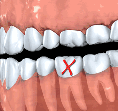 【經典案例 】男子缺了一顆牙不及時修復，結果又痛失兩顆鄰牙 未分類 第1張