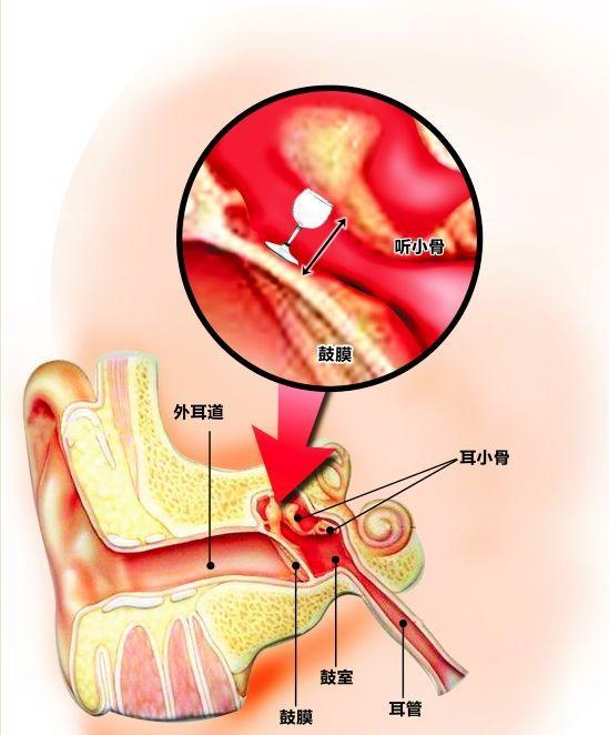 详细了解——中耳炎的分类(转载)_鼓膜